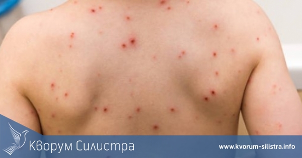 Силистренско НПО иска ваксината срещу варицела да стане задължителна в България