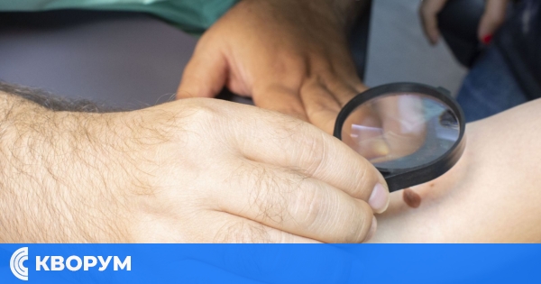 Слънцето е опасно за някои видове бенки