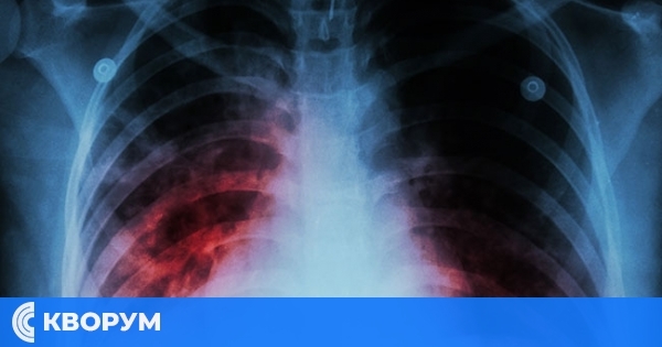 Безплатни прегледи за туберкулоза в Силистра от 23 до 27 юни