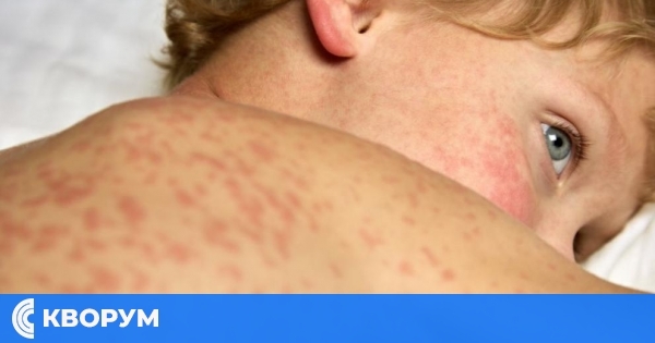 Морбили сред деца: здравните власти с предупреждение